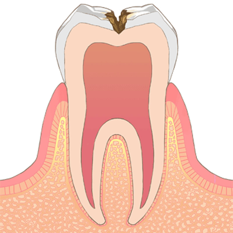 虫歯レベル2
