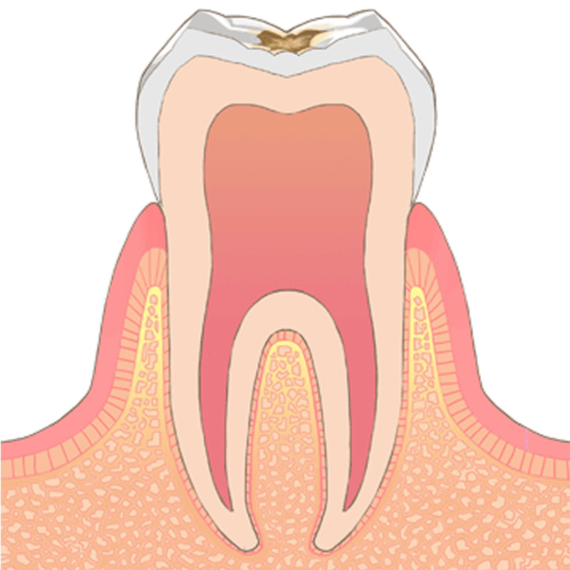 虫歯レベル1