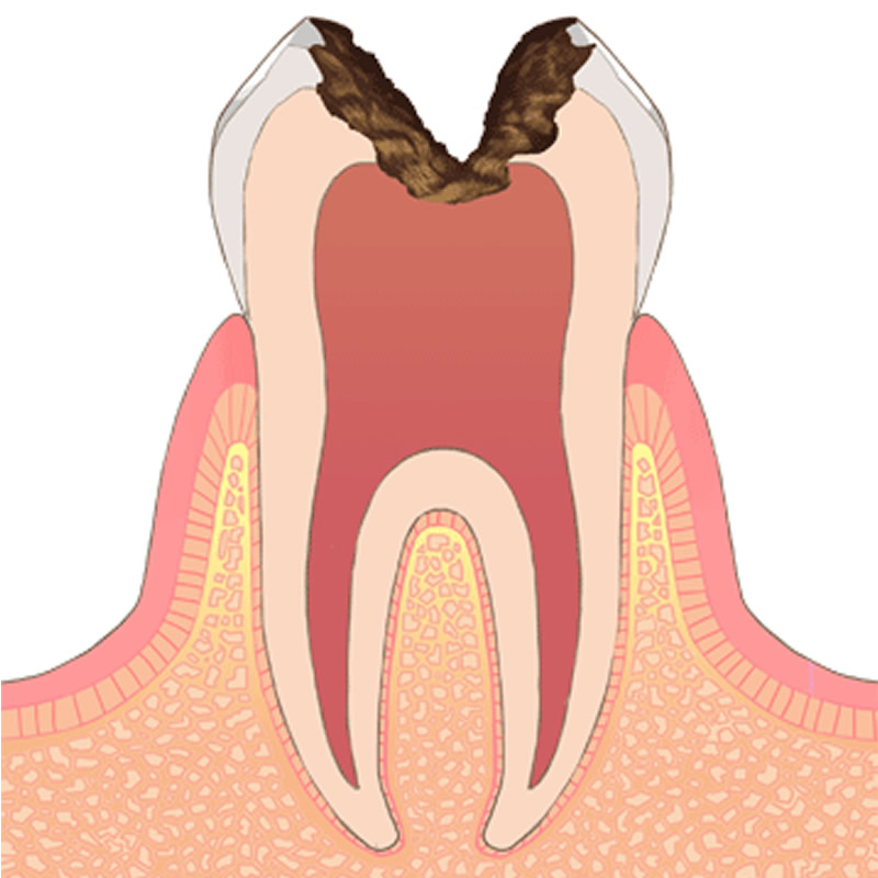 虫歯レベル3